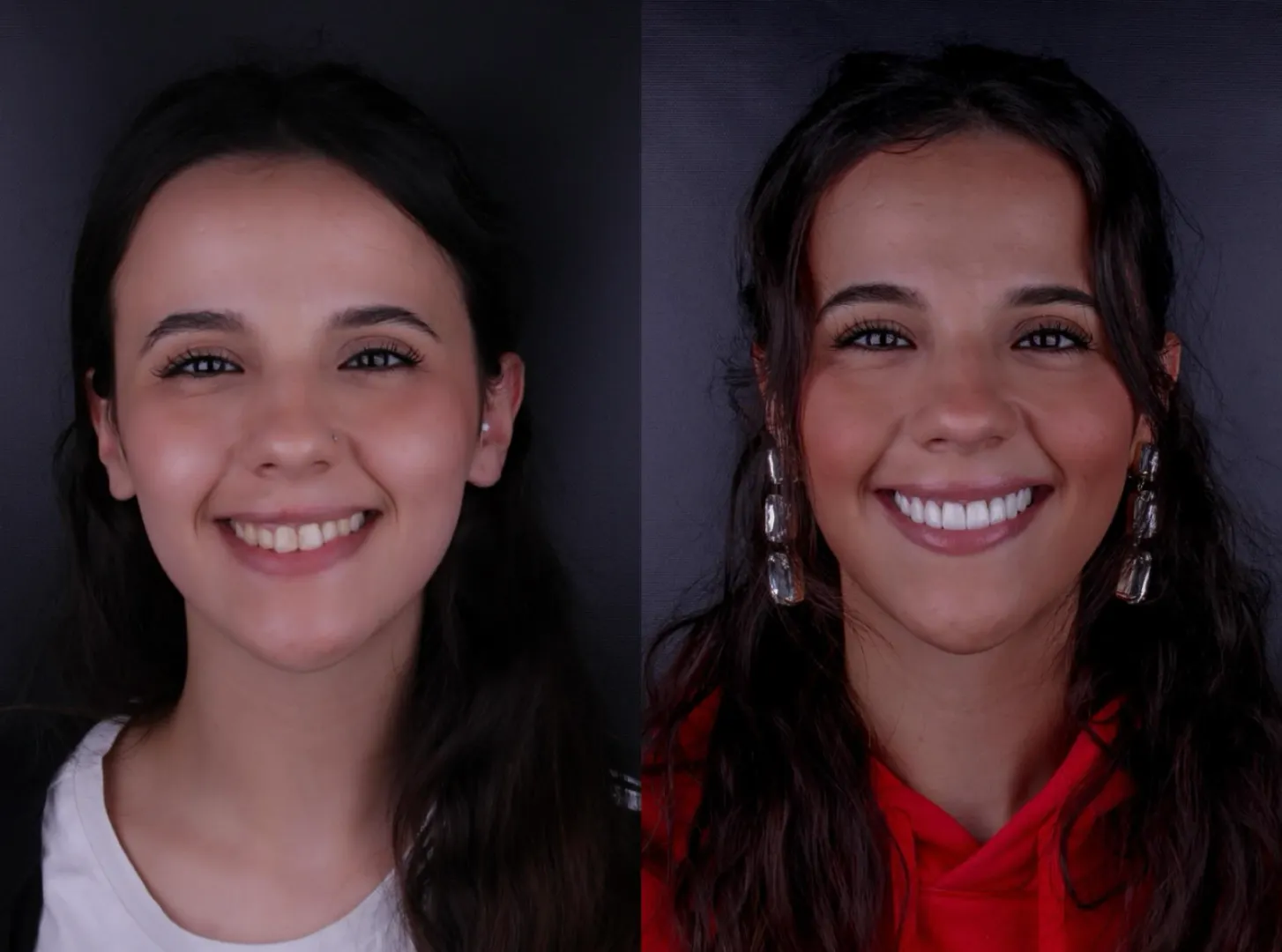 dISEÑO DE SONRISA